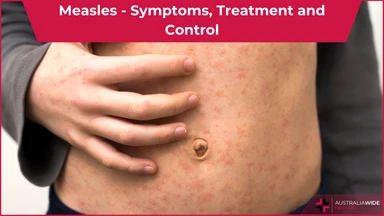 Measles article header